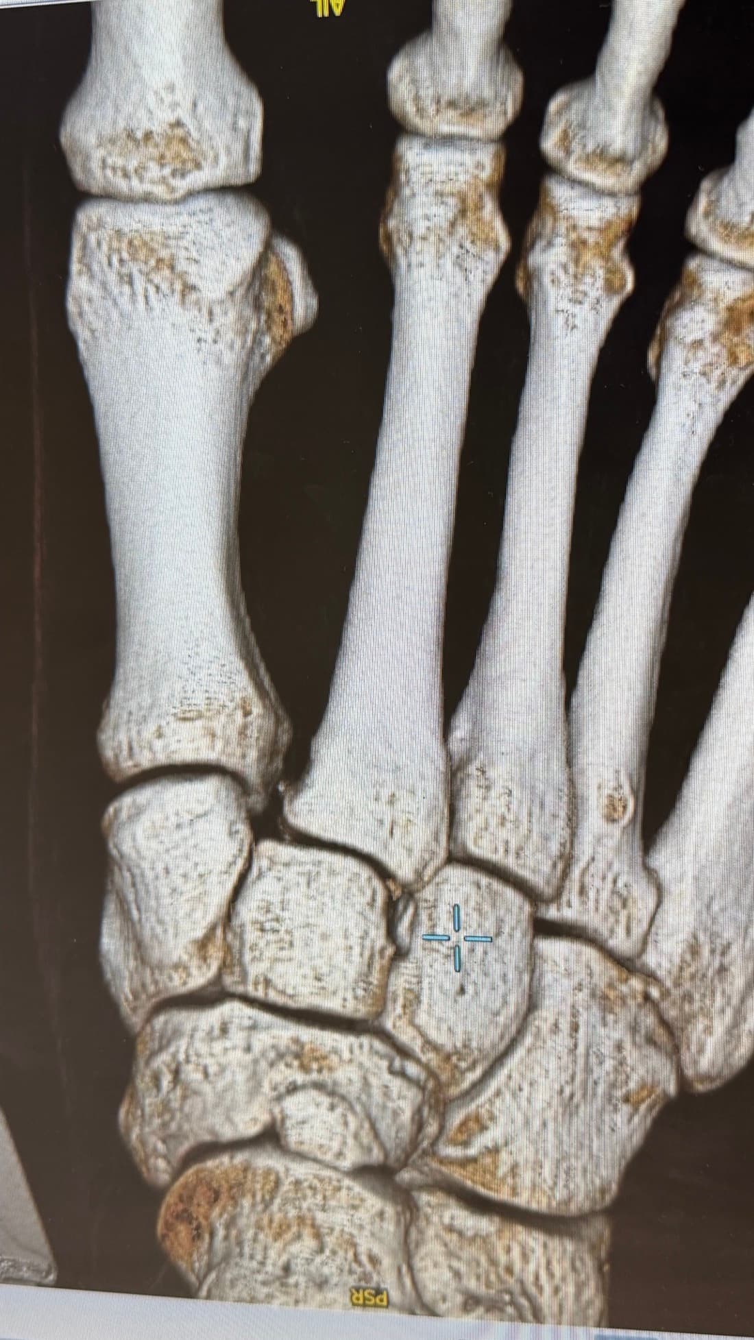 3D CT scan of Toby's foot showing the injured bones