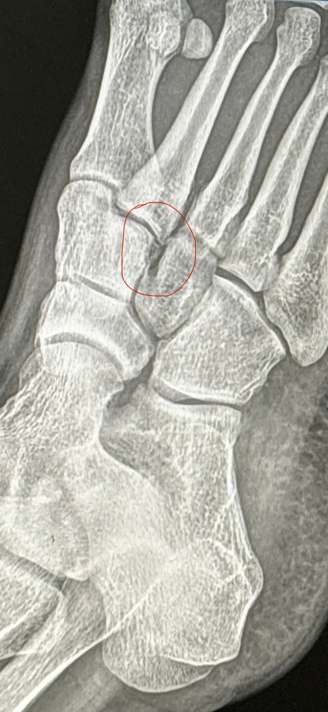 X-ray of Toby's foot with the injury circled